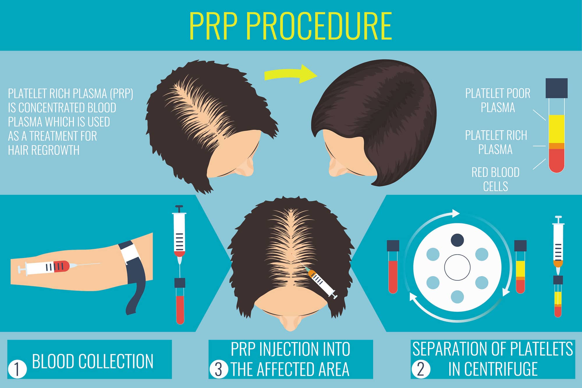 PRP Non-Surgical Treatment for Alopecia | IK Clinics
