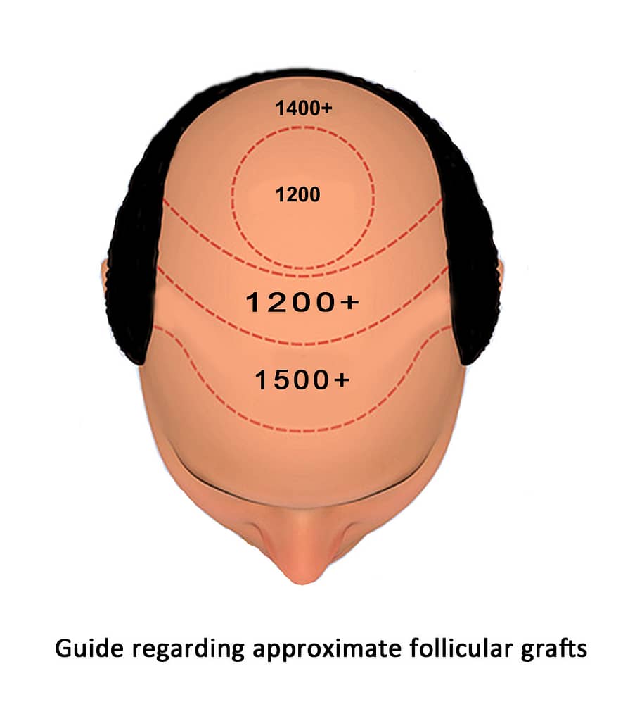 IK Clinics Guide-regarding-follicles-needed-in-hair-transplant-jpg How much does a hair transplant cost?  