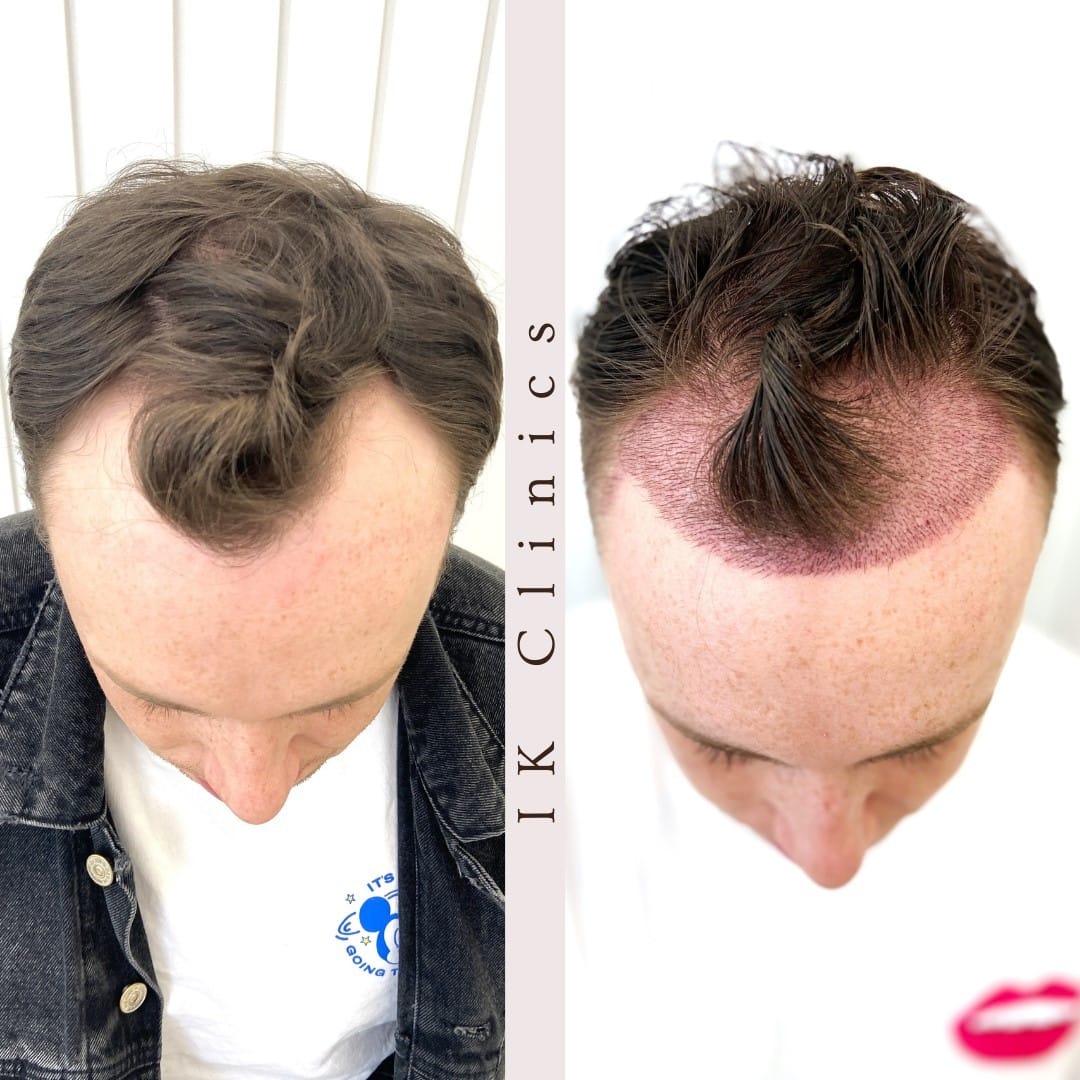 Hair Transplants UK | Hairloss & PRP Clinic Leicester